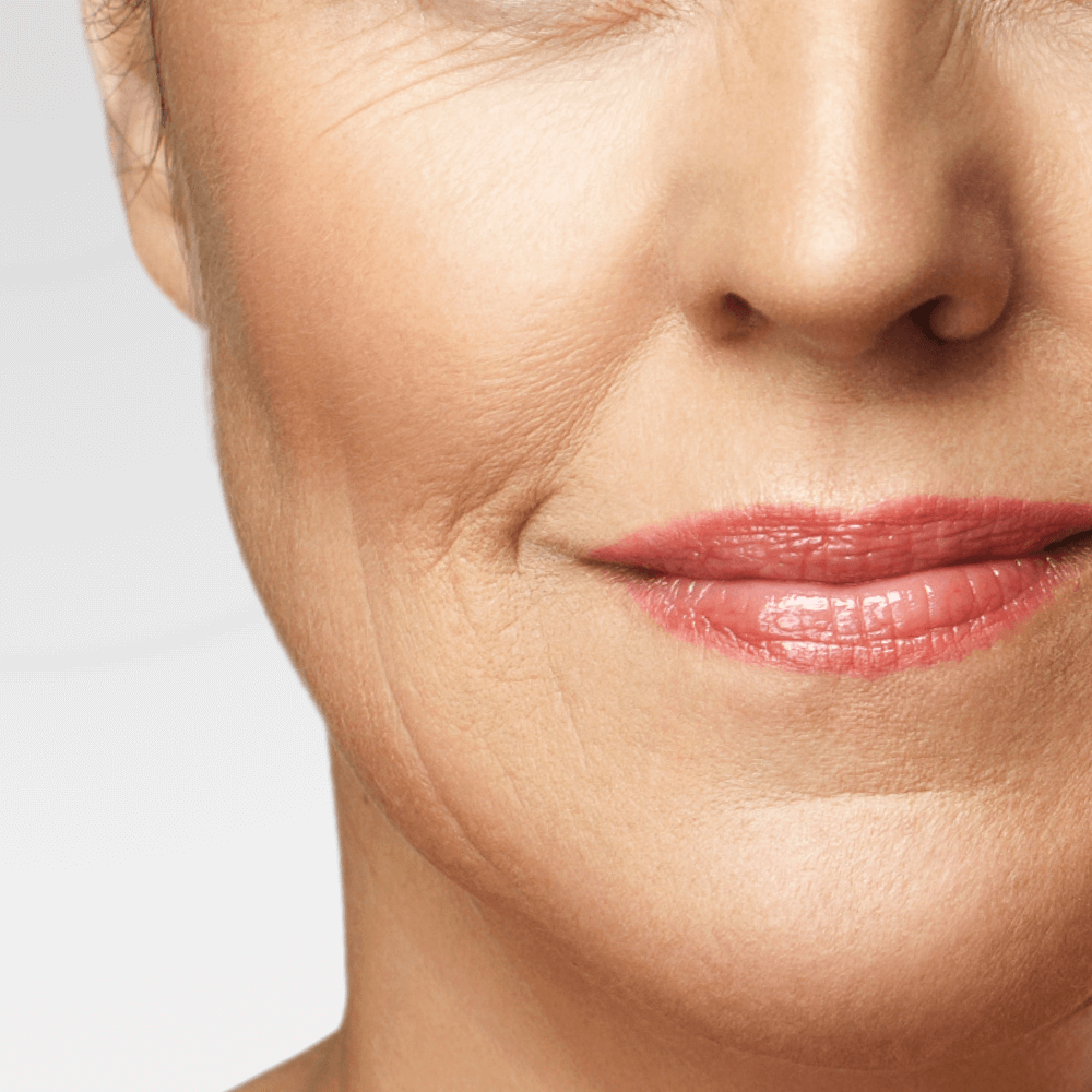 Fine Lines & Wrinkles Treatment