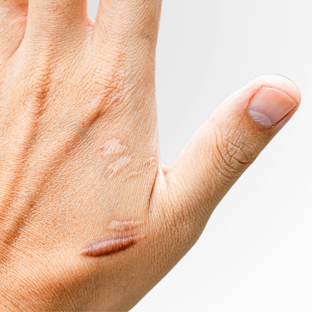 Keloid Scar Treatment