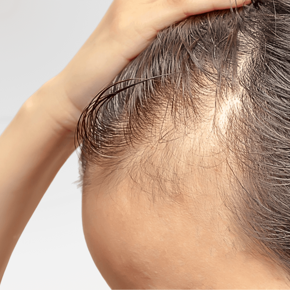 hair growth treatment clinic kuala lumpur