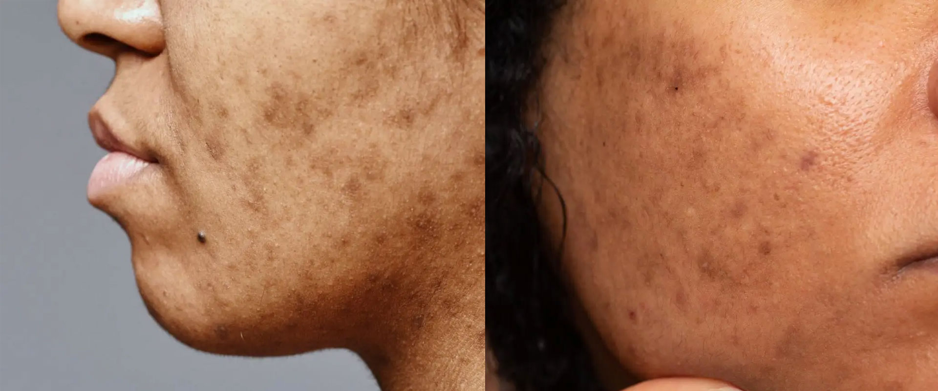 hyperpigmentation in Kuala Lumpur